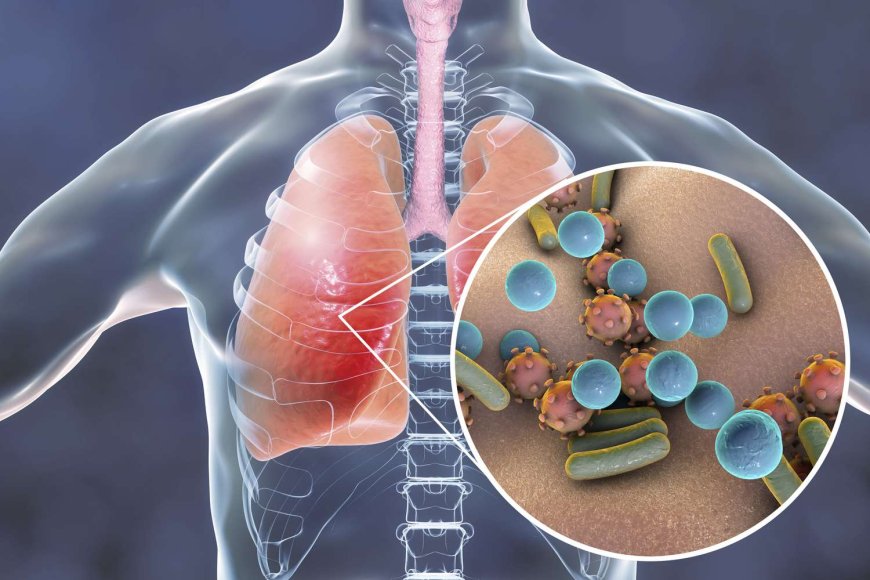 The Connection Between Pneumonia and Chronic Illnesses: What You Need to Know