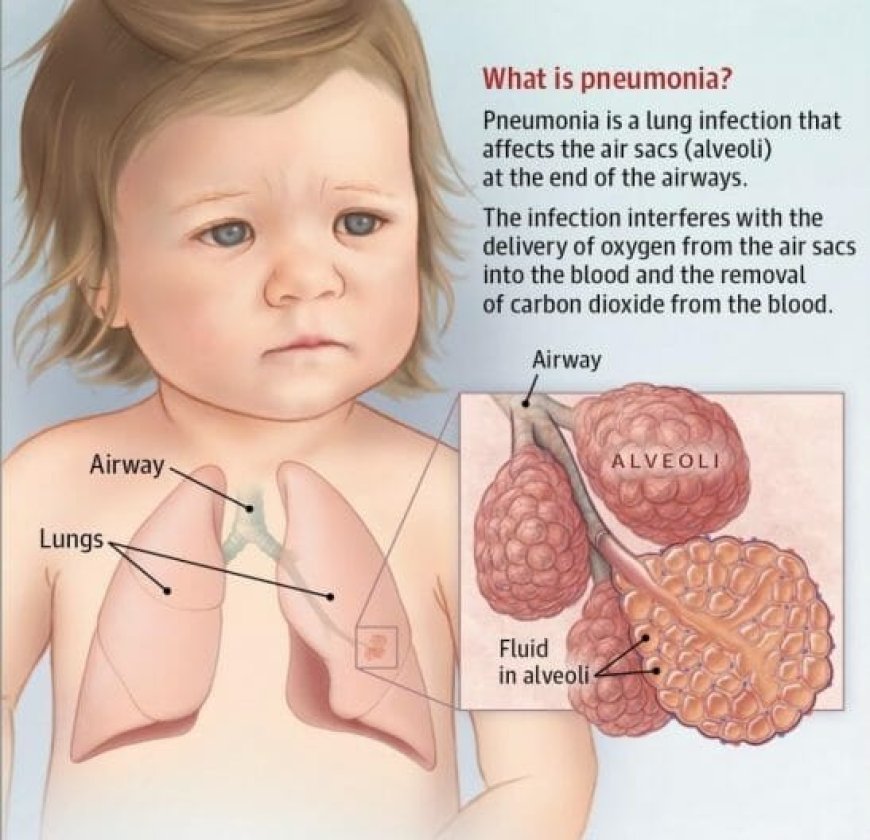 The Connection Between Pneumonia and Chronic Illnesses: What You Need to Know