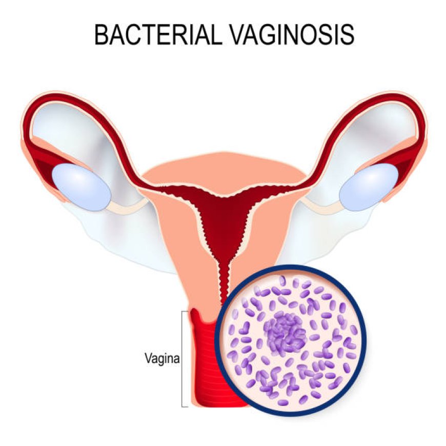 "Bacterial Vaginosis: Causes, Symptoms, and Treatment | Your Ultimate Guide"