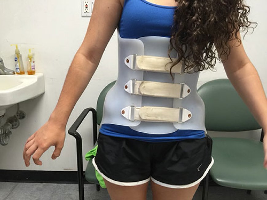 Straightening Things Out: How to    Treat Scoliosis
