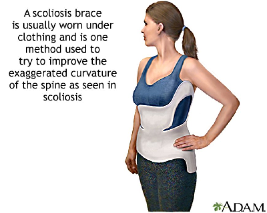 Straightening Things Out: How to    Treat Scoliosis