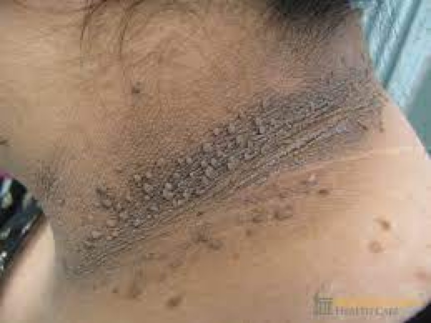 "Acanthosis Nigricans And Diabetes: What You Need To Know"