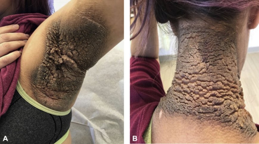 "Acanthosis Nigricans And Diabetes: What You Need To Know"