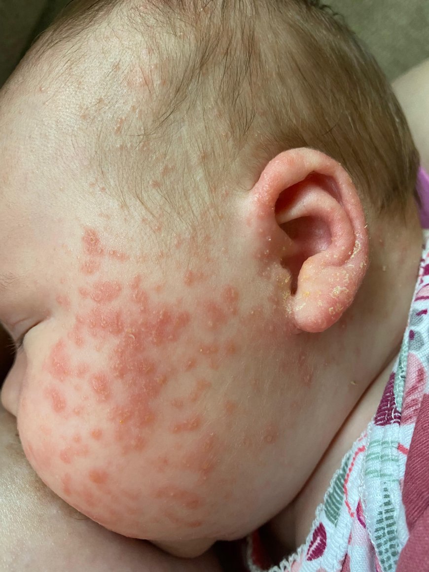"Baby Acne: What Every New Parent Needs To Know"
