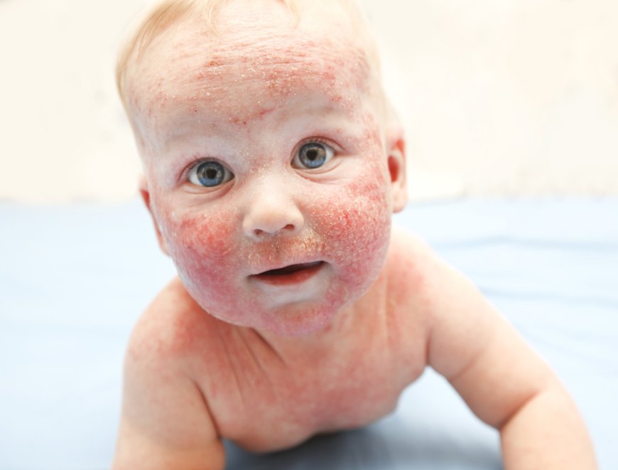 "Baby Acne: What Every New Parent Needs To Know"