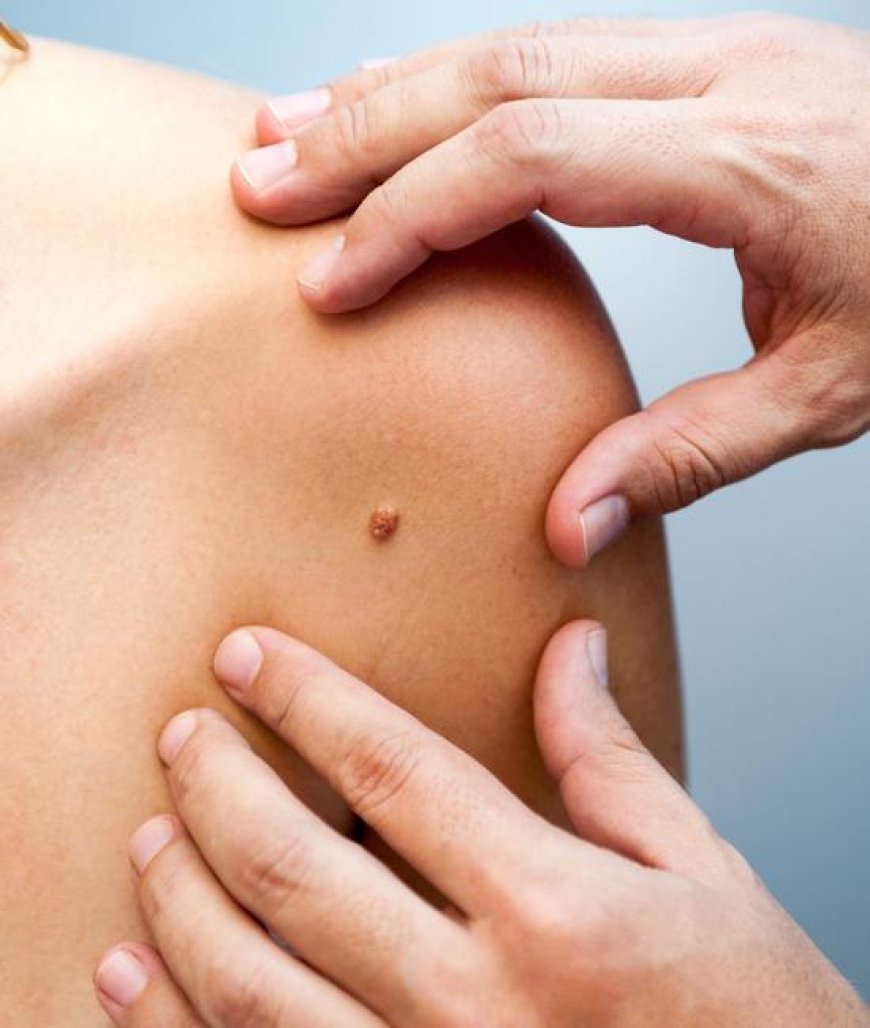 "The ABCDEs Of Melanoma: How To Recognize Early Signs And Symptoms"