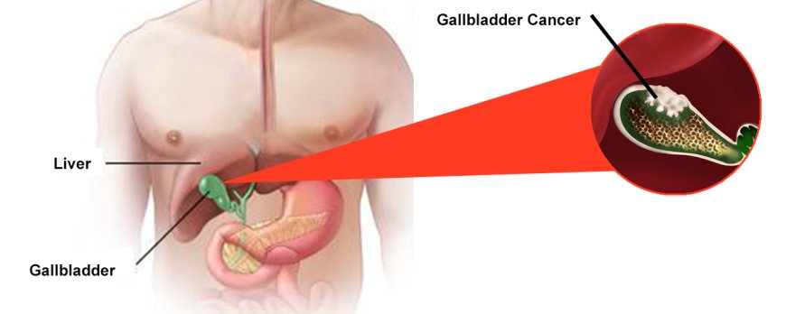 "Overcoming Gallbladder Cancer: Strategies for Improving Quality of Life".