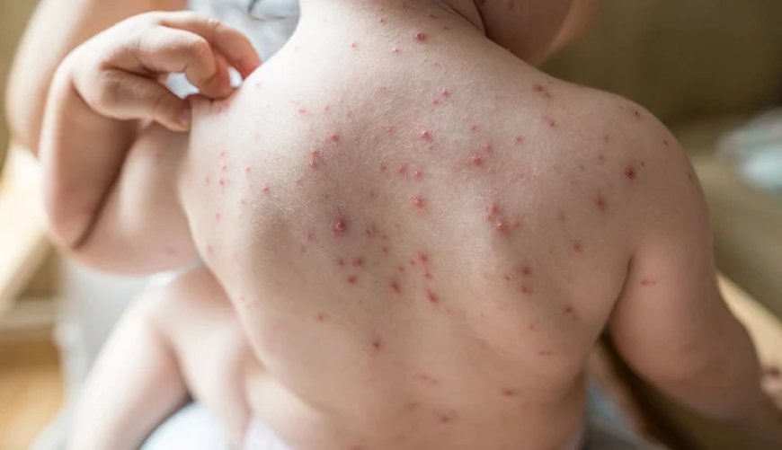 Chickenpox 101: What You Need To Know