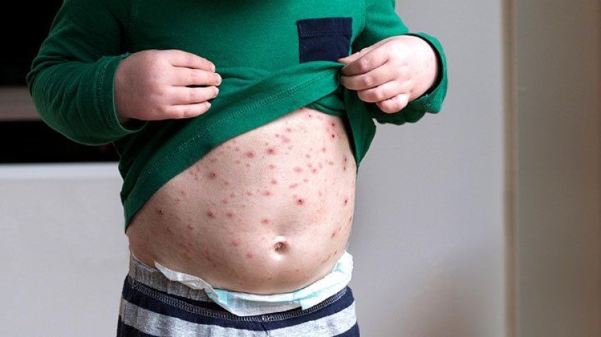 Chickenpox 101: What You Need To Know