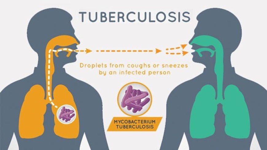 "The Silent Killer: Tuberculosis And Its Impact On Global Health"