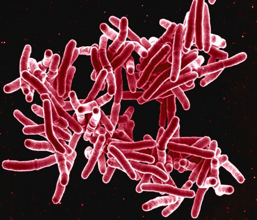 "The Silent Killer: Tuberculosis And Its Impact On Global Health"