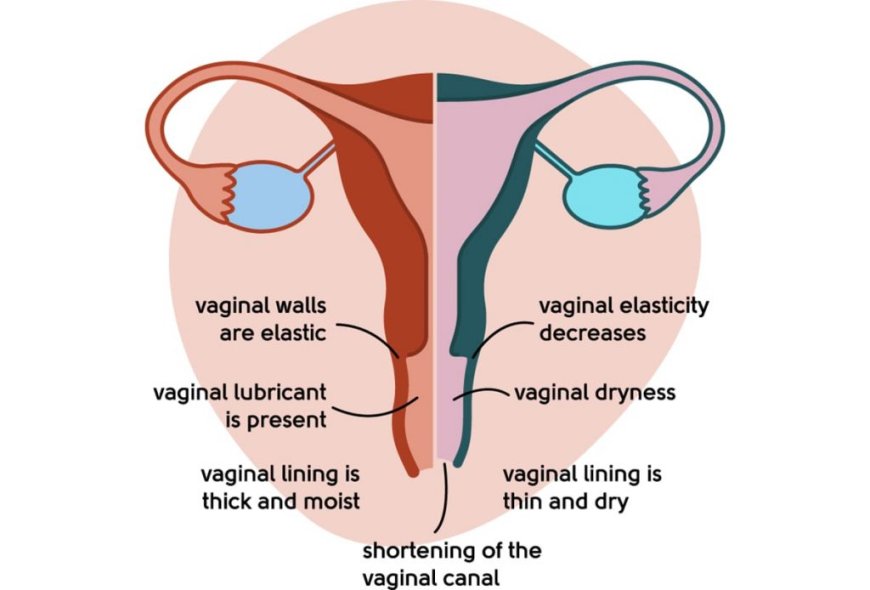"Beyond Lubrication: Managing Vaginal Atrophy For Better Intimacy"