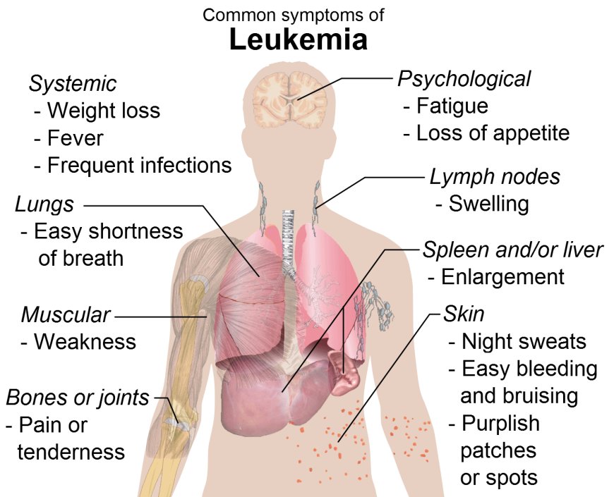The Latest Research on Leukemia: Breakthroughs and Innovations