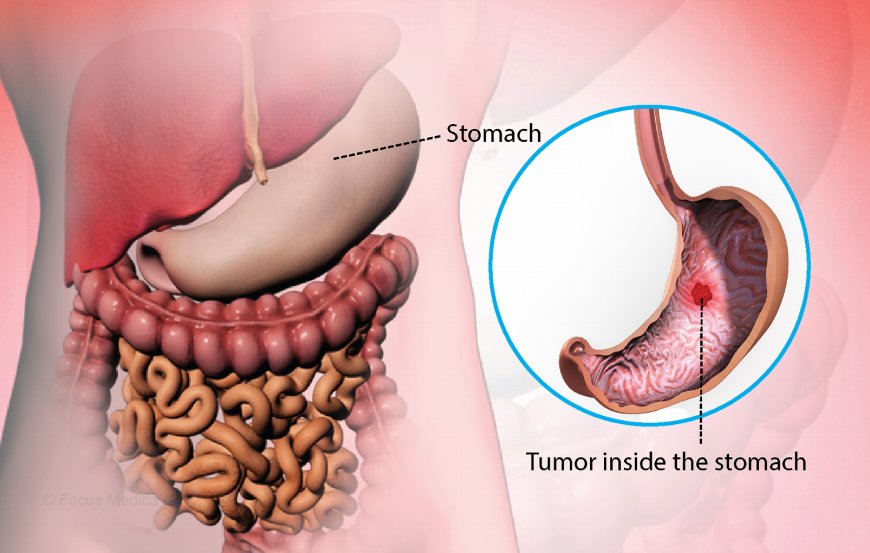 'Understanding Stomach Cancer: Causes, Symptoms, and Treatment Options'