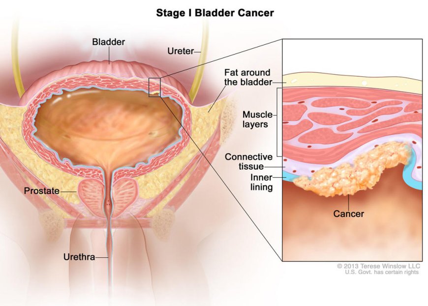 Bladder Cancer: Understanding the Silent Killer