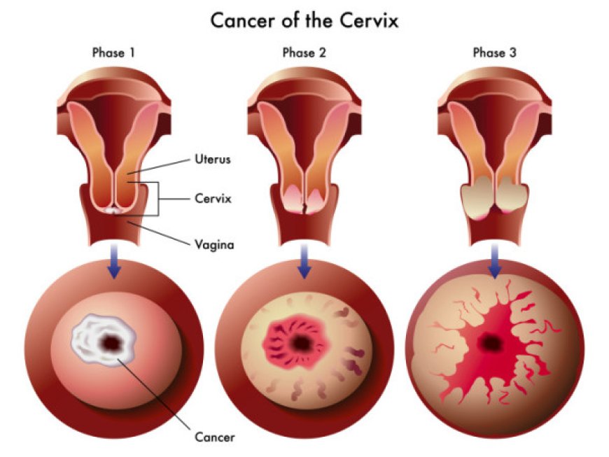 'Cervical Cancer in Young Women: What You Need to Know'