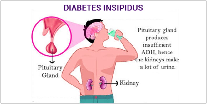 The Hidden Challenge: Understanding Diabetes Insipidus