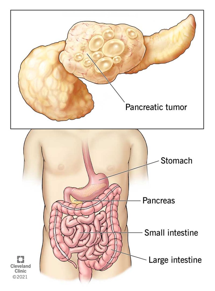 "Hope on the Horizon: Emerging Therapies in Pancreatic Cancer Research"
