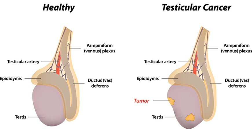 "Detecting Testicular Cancer Early: Your Key To Successful Treatment"