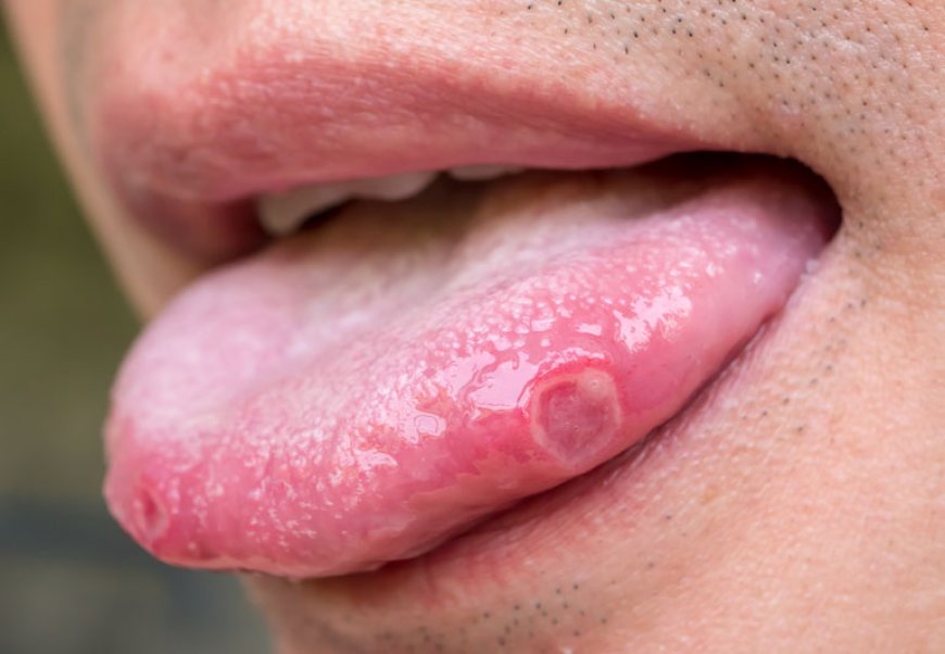 “Mouth Ulcers: When To Worry And How To Treat Them”